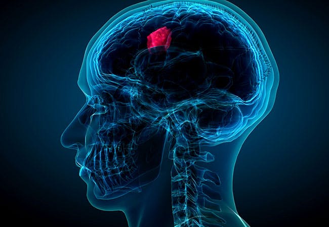 A brain tumor highlighted in red on an x-ray styled graphic of a human head.